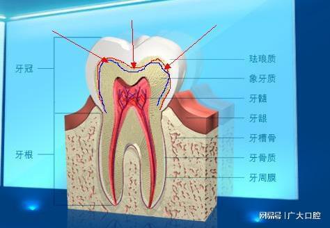 宝威体育官网：美容冠真能帮牙齿美容？小心不成牙齿反变“钉子”(图3)