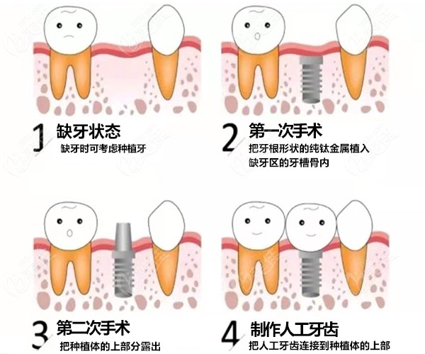 宝威体育下载网站：宝威体育：幸立得-5分钟种好一颗牙 引起国际口腔种植技术高峰论