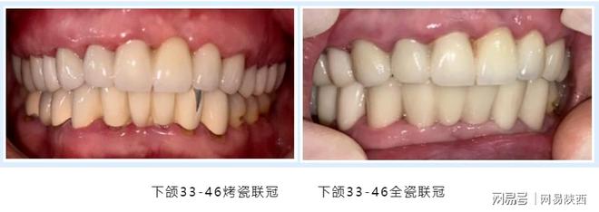 全瓷牙修复 从捂嘴笑到开口笑(图2)