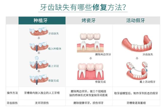 掉牙也传染？牙齿成排掉怎么办？医生建议及时种植修复稳固牙槽骨