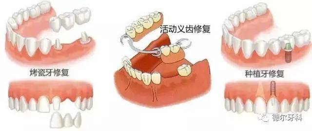 宝威体育：军人修复牙齿在军内及地方医院报销流程！