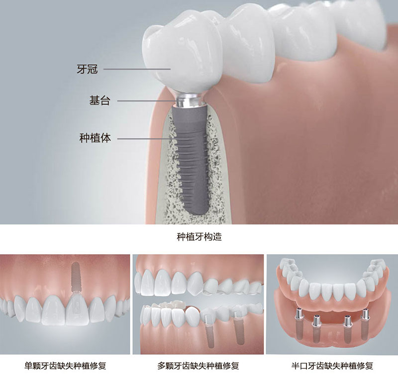 了解种牙新技术让种牙限制不再是限制