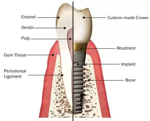 宝威体育官网：宝威体育下载网站：Dental implant│正确认识植牙技术