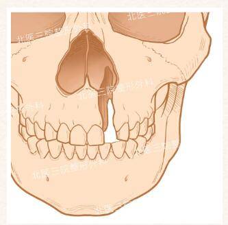 宝威体育下载网站：宝威体育：【唇裂鼻畸形】牙槽脊裂修复(图1)