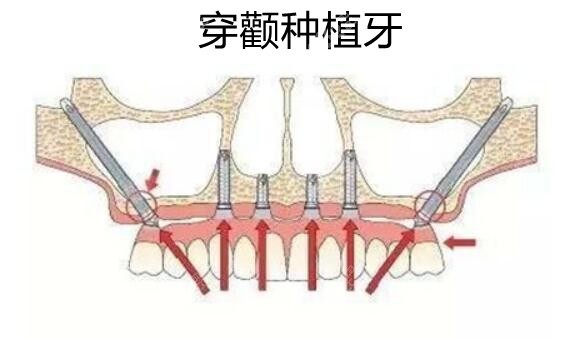 目前先进的全口种植牙技术就有穿颧穿翼、ALL-ON-46等(图2)