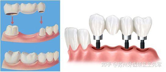“每日科普”南京种植牙医院比较好口碑_老人种牙好还是镶牙好
