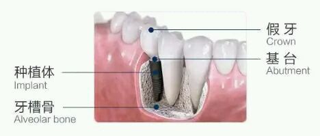 宝威体育官网：种植牙步骤都有哪些你知道吗？