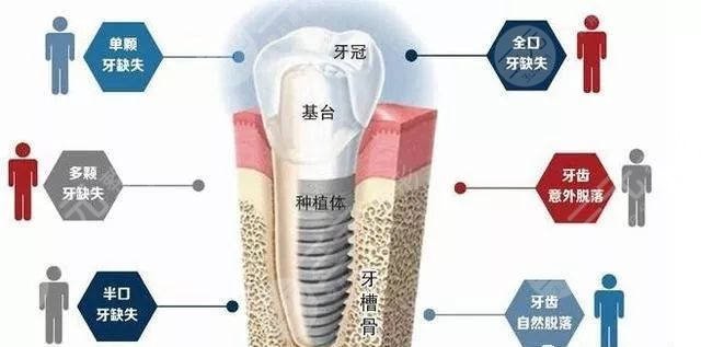 美呀植牙等头部机构以创新技术赢得优势